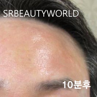 이마주름 시술 후