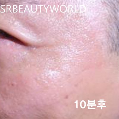 눈가주름 시술 후