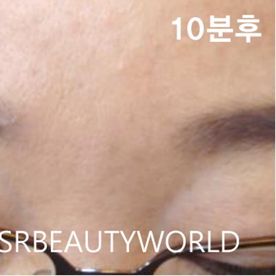 미간주름 시술 후