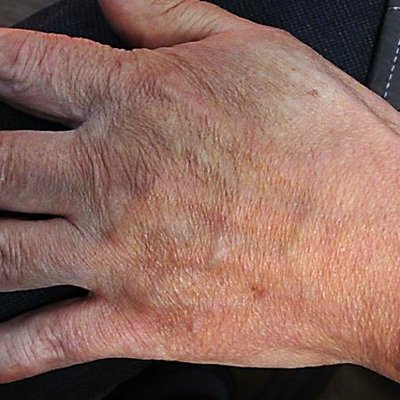 손등주름 시술 전